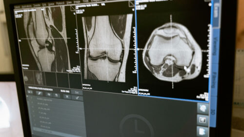 Bild einer digitalen Bildanalyse des Kniegelnks